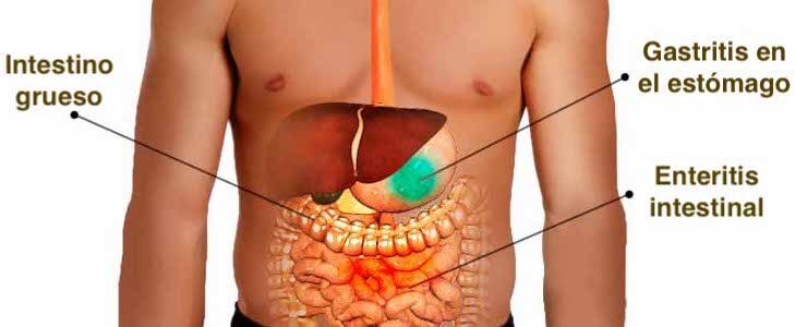 Sintomas de la gastritis
