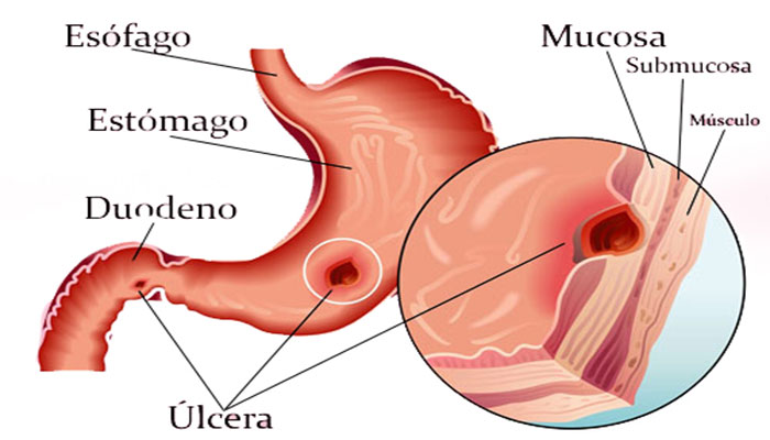 úlcera-gástica
